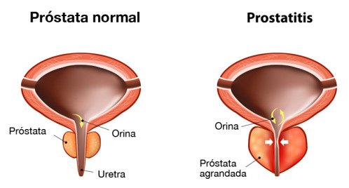 prostatitis az angina miatt állandó pisi inger