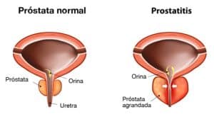 Prostatitis