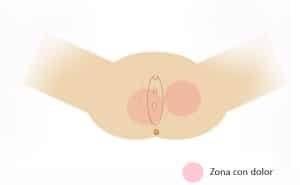 Vulvodinia generalizada