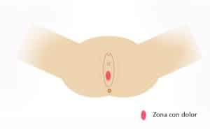 Vulvodinia localizada